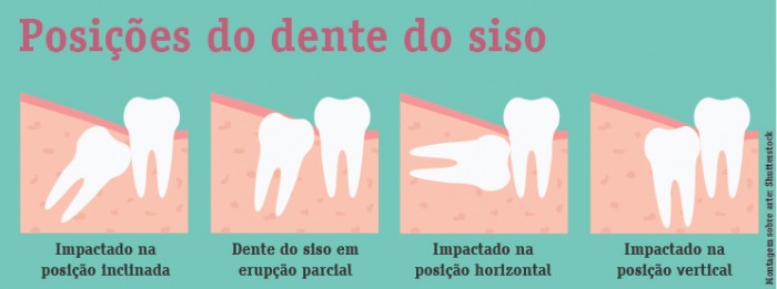 Cirurgia do Siso