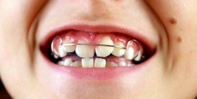 aparelho-ortodontico-infantil
