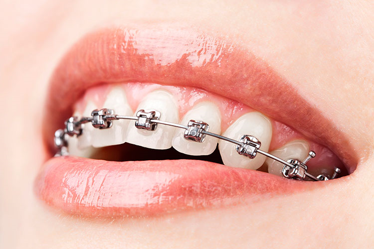 aparelhos-ortodonticos-