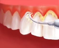 DENTE COM TÁRTATO E REMOÇÃO COM APARELHO ESPECÍFICO.