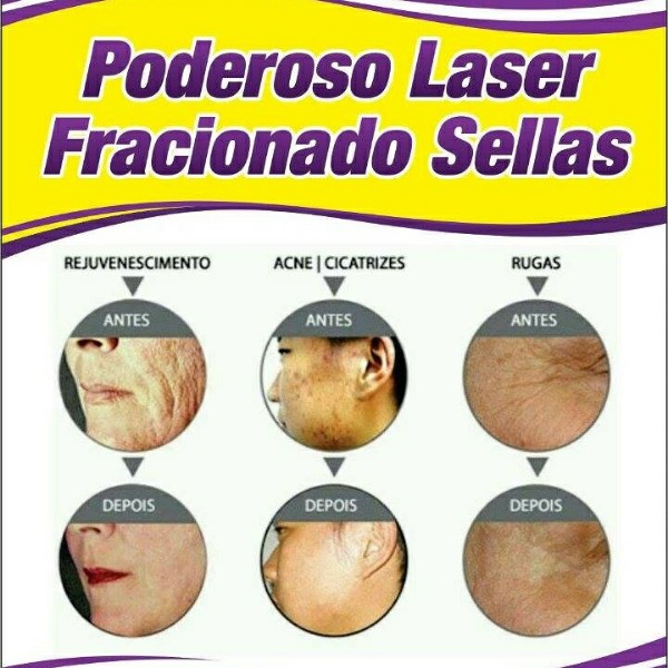 laser-facial-estrias-fracionado