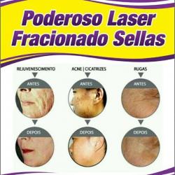 Saúde e beleza - laser facial / estrias fracionado - laser facial / estrias fracionado